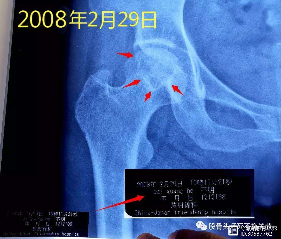 攀枝花人工骨头医保报销多少(人工骨头医保报销多少比例)