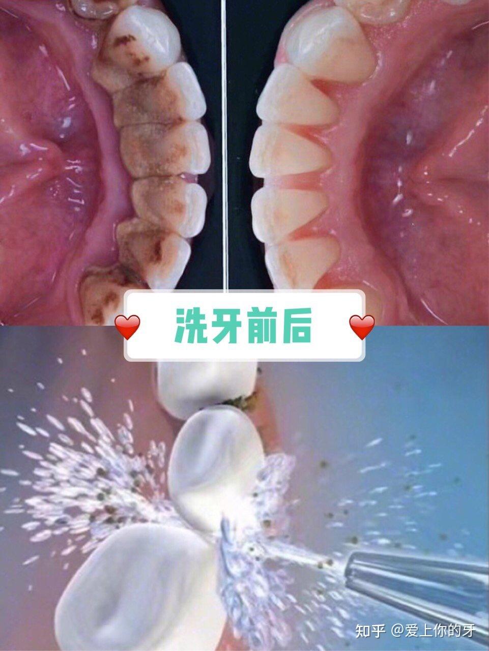 攀枝花洗牙可以用医保吗(洗牙可以用医保吗,报销比例多少)